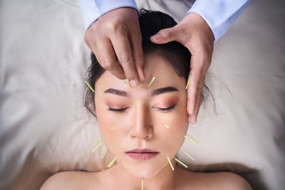 Acupuncture