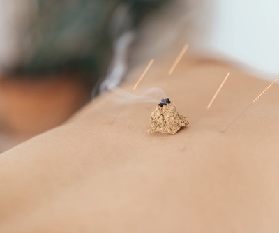 Moxibustion