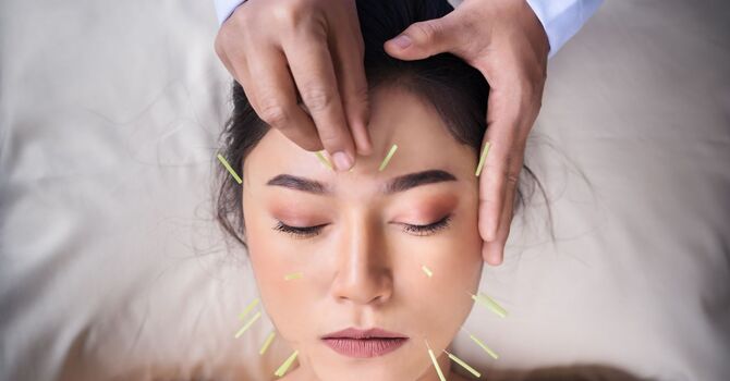 What Is Acupuncture? 